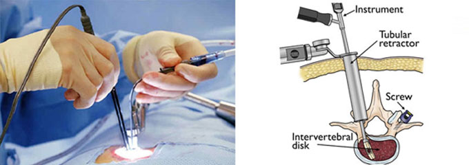 Minimally Invasive Spine Surgery