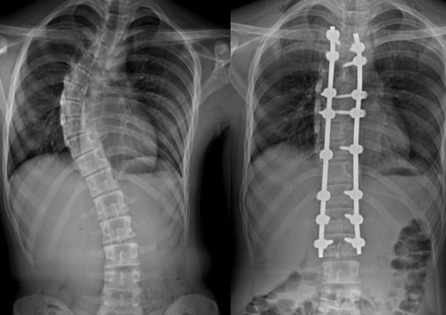Scoliosis