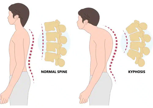 Kyphosis