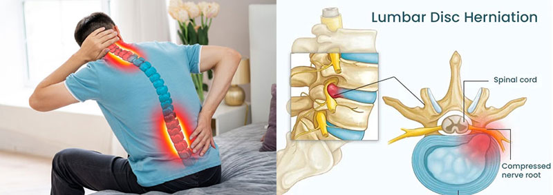 Cervical & Lumbar Disc Prolapse