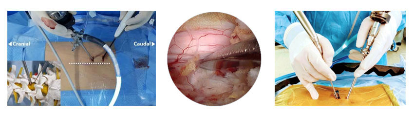 Endoscopic Spine Surgery