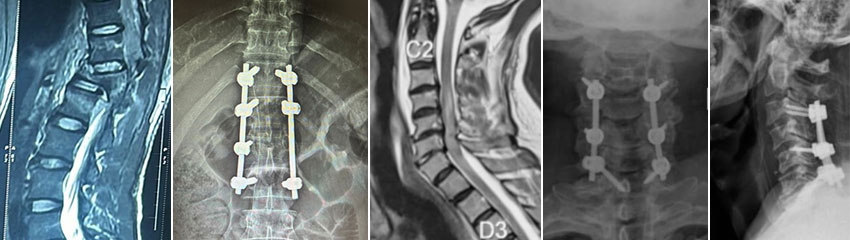 Spinal Fractures & Trauma