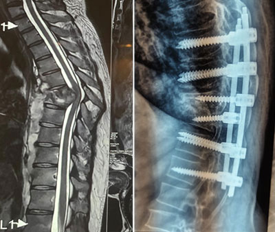 Spinal Tuberculosis