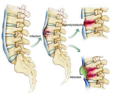 Spine Infections
