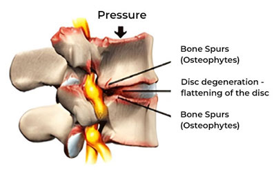 Degenerative Spine Conditions