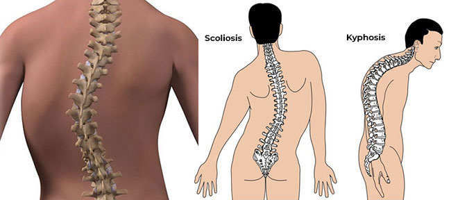 Spinal Deformities