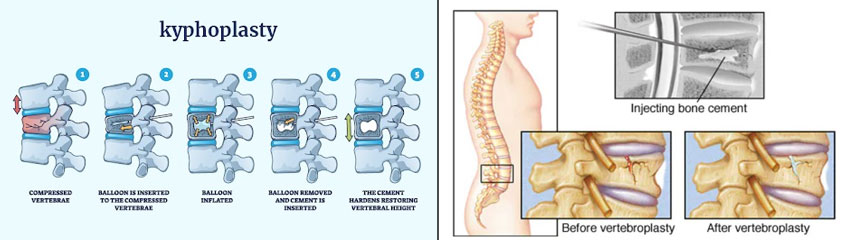 Osteoporotic Spine Fractures
