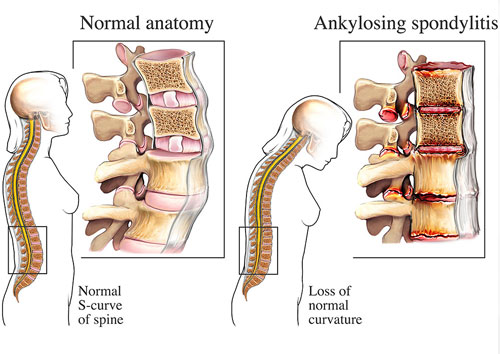 Ankylosing Spondylitis