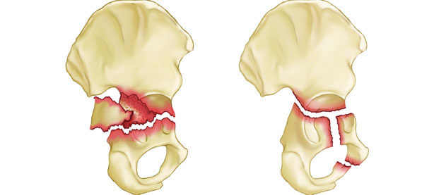 Pelvi Acetabular Fractures