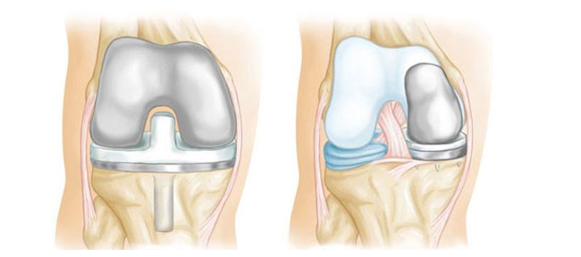 Partial Knee Replacement