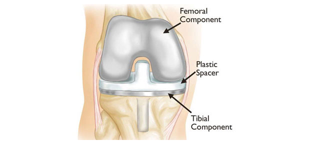 Primary & Revision Total Knee Replacement