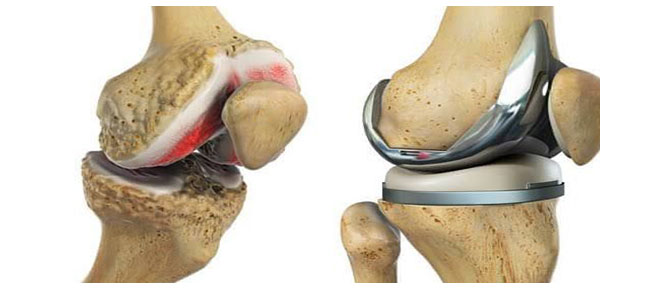 Robotic Joint Replacement Surgery