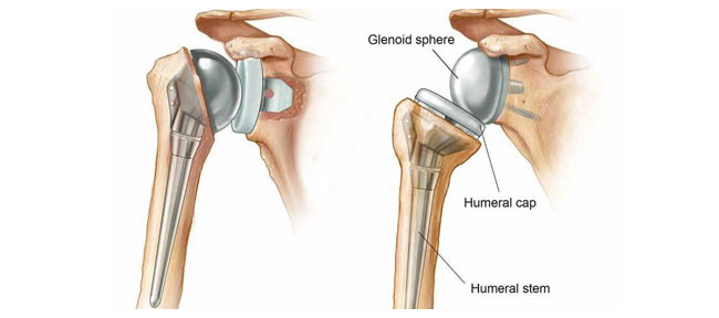 Shoulder & Reverse Shoulder Replacement