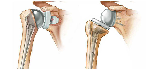 Shoulder Replacement
