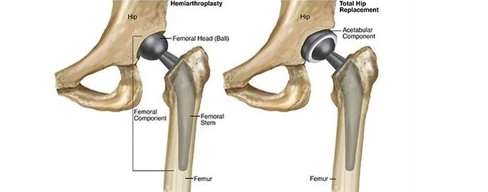 Hemi & Total Hip Replacement Surgery