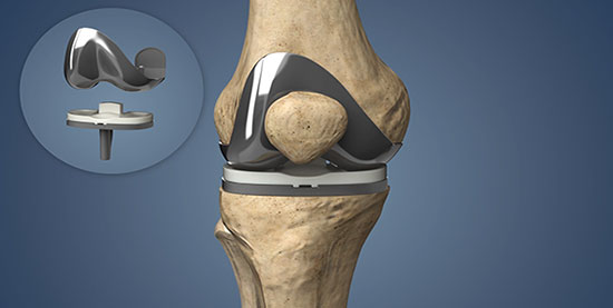 Total Knee Replacement