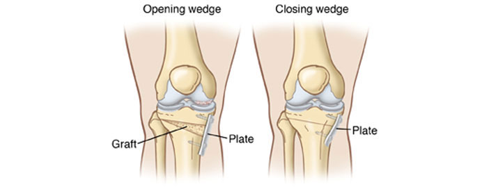 Knee osteotomies
