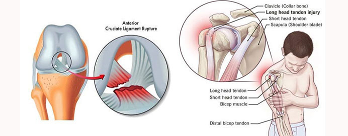 Tendon & ligament injuries