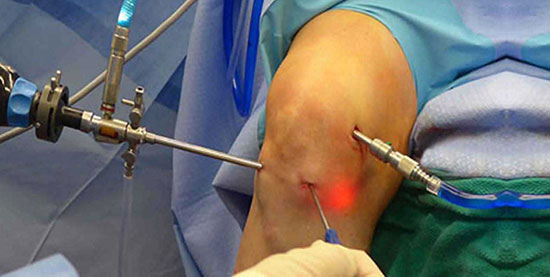 Arthroscopic Surgeries
