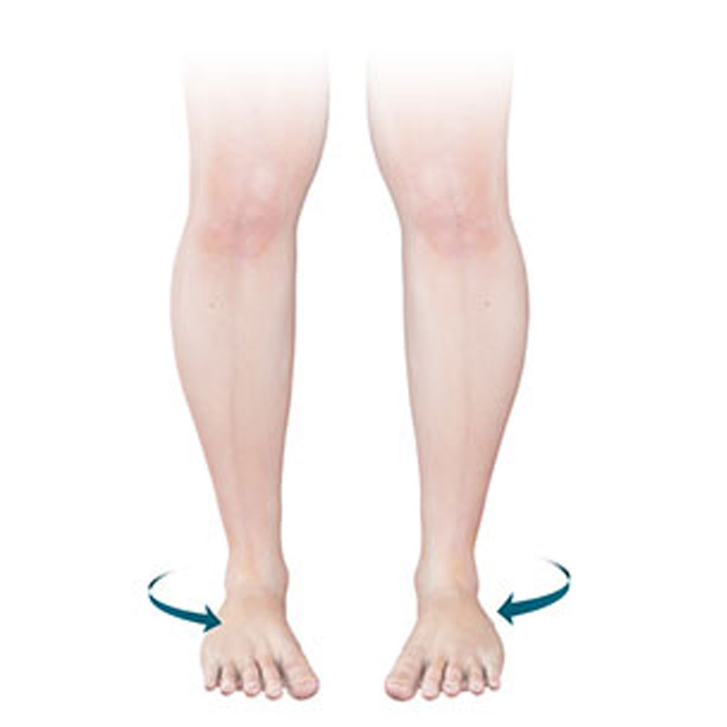 Limb Deformities