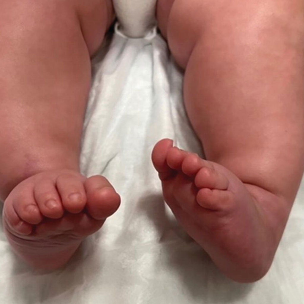 Foot Deformities