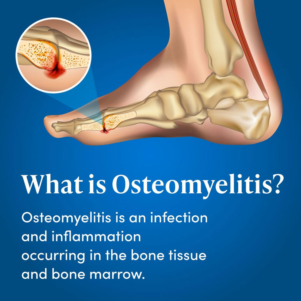 Osteomyelitis