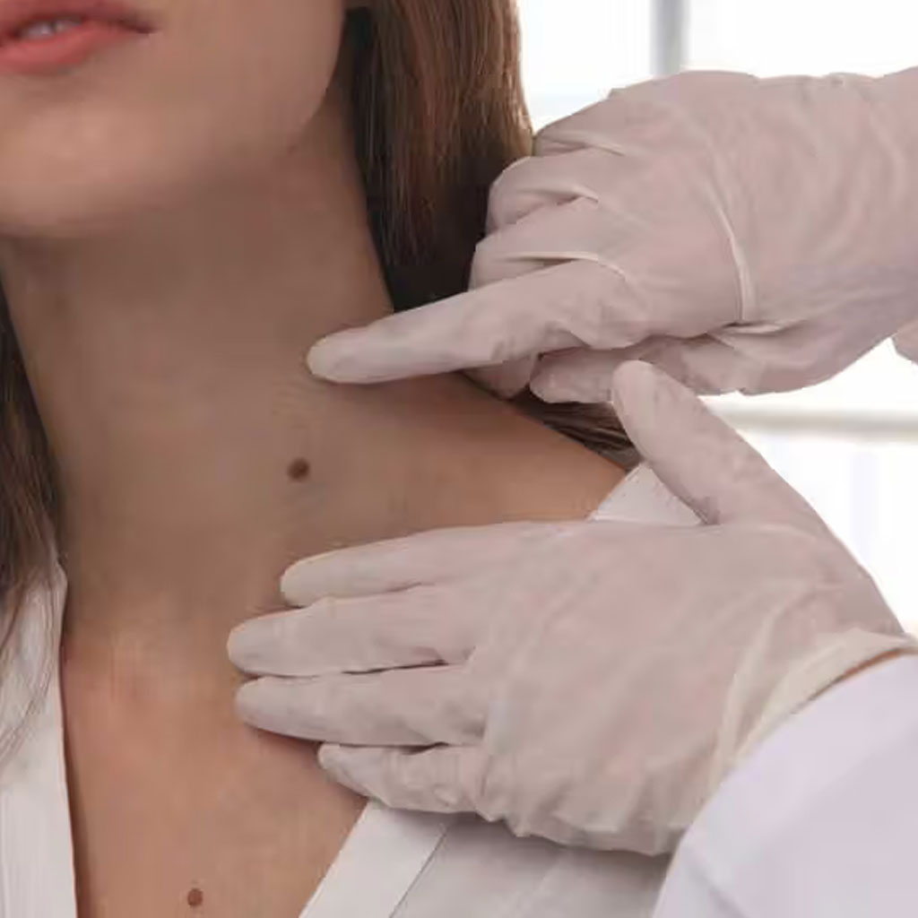 Benign Tumors