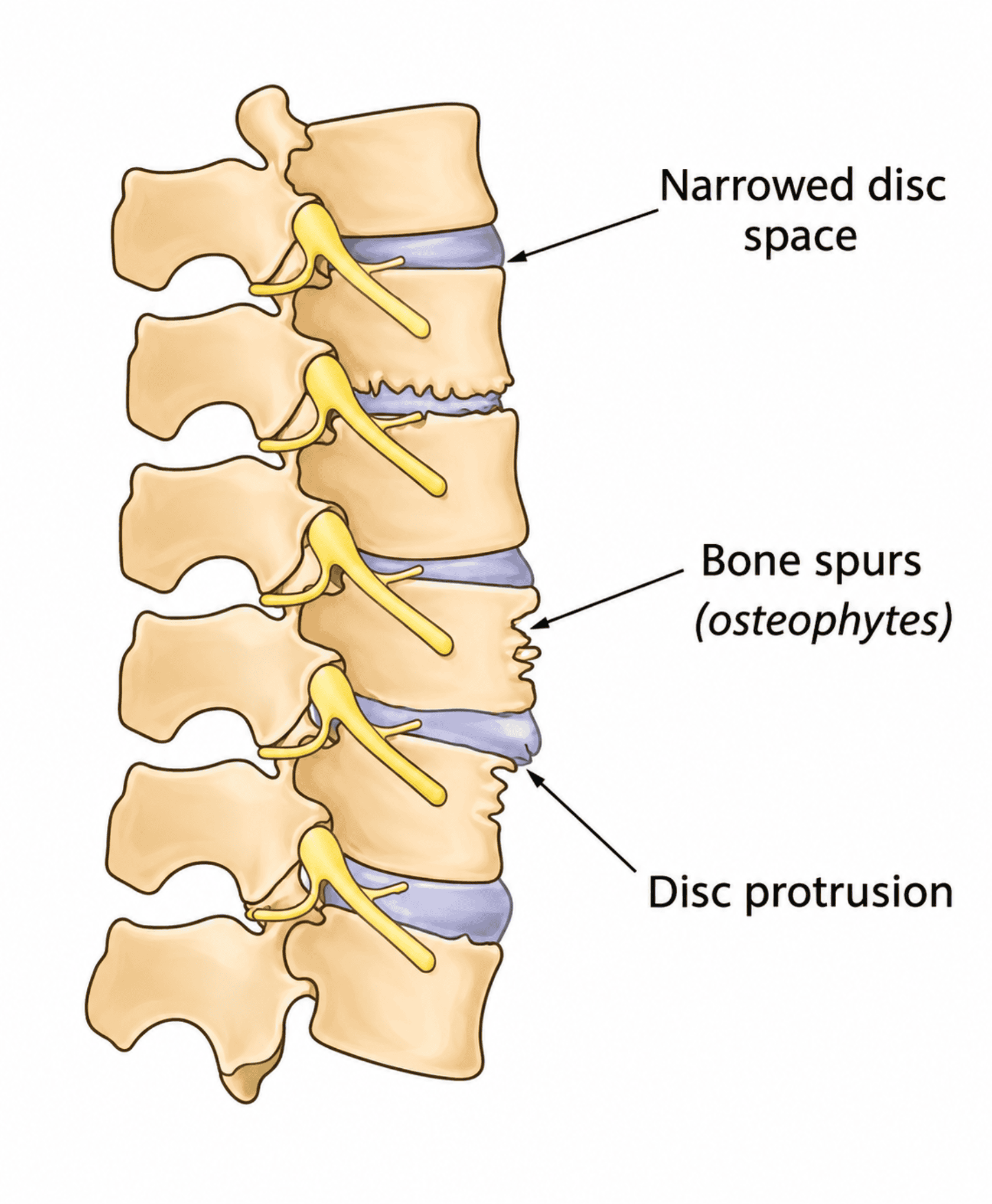 Spondylosis