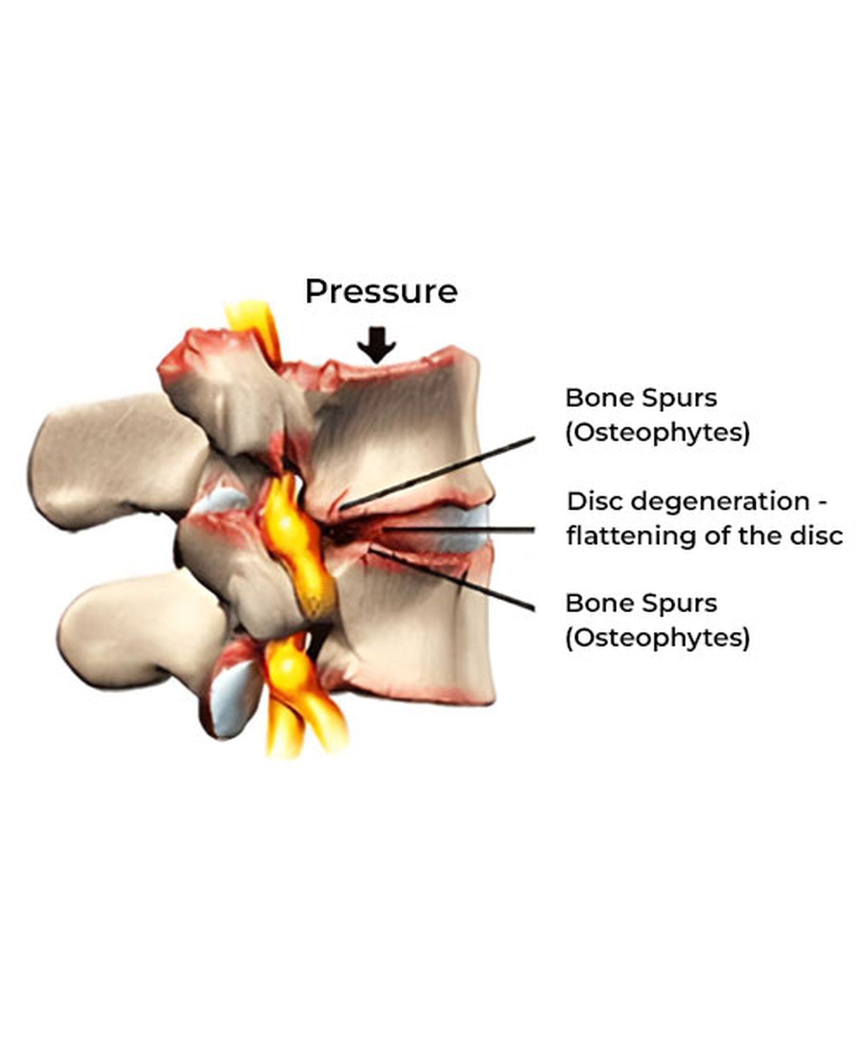 Degenerative Spine Conditions​