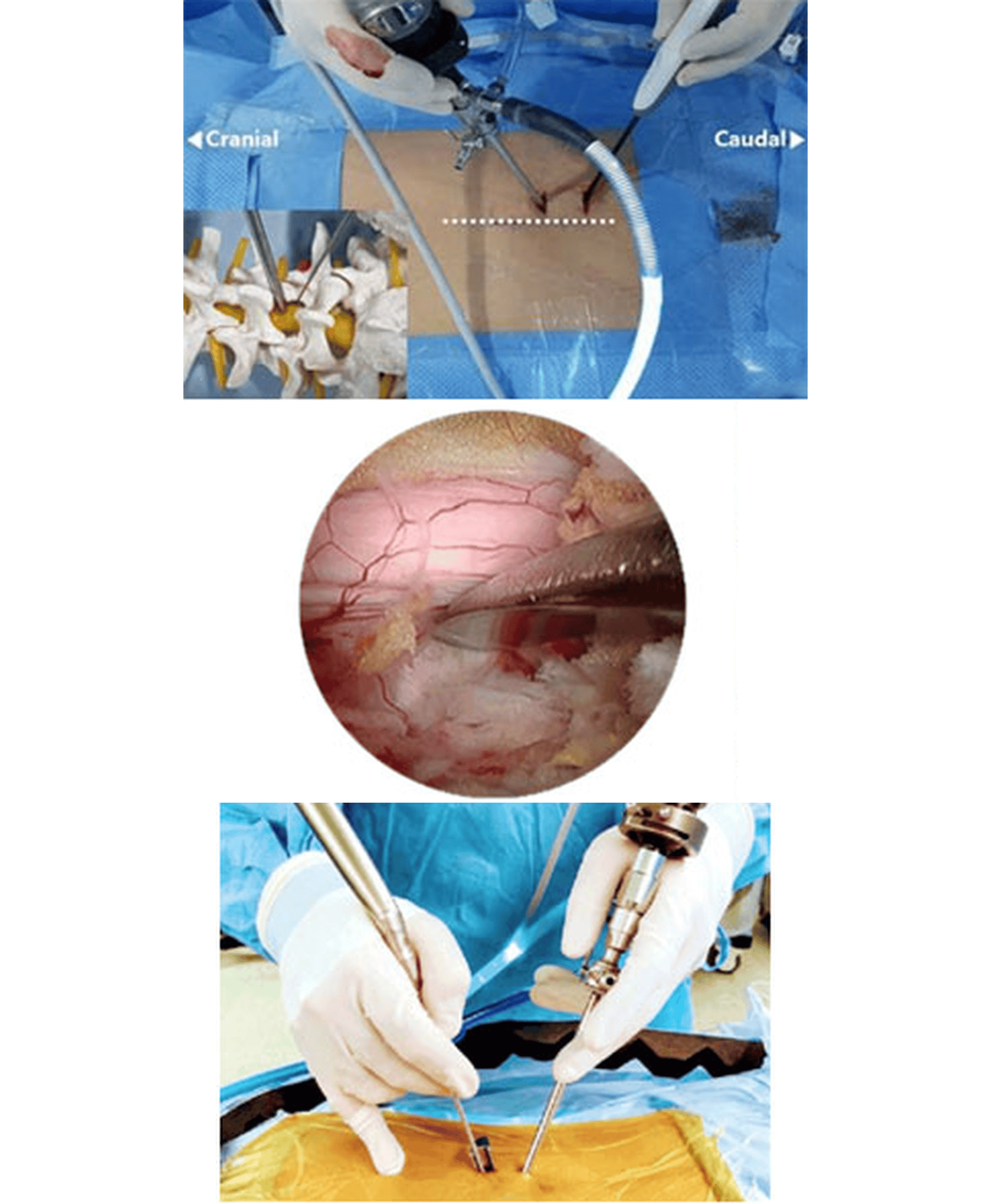 Endoscopic Spine Surgery