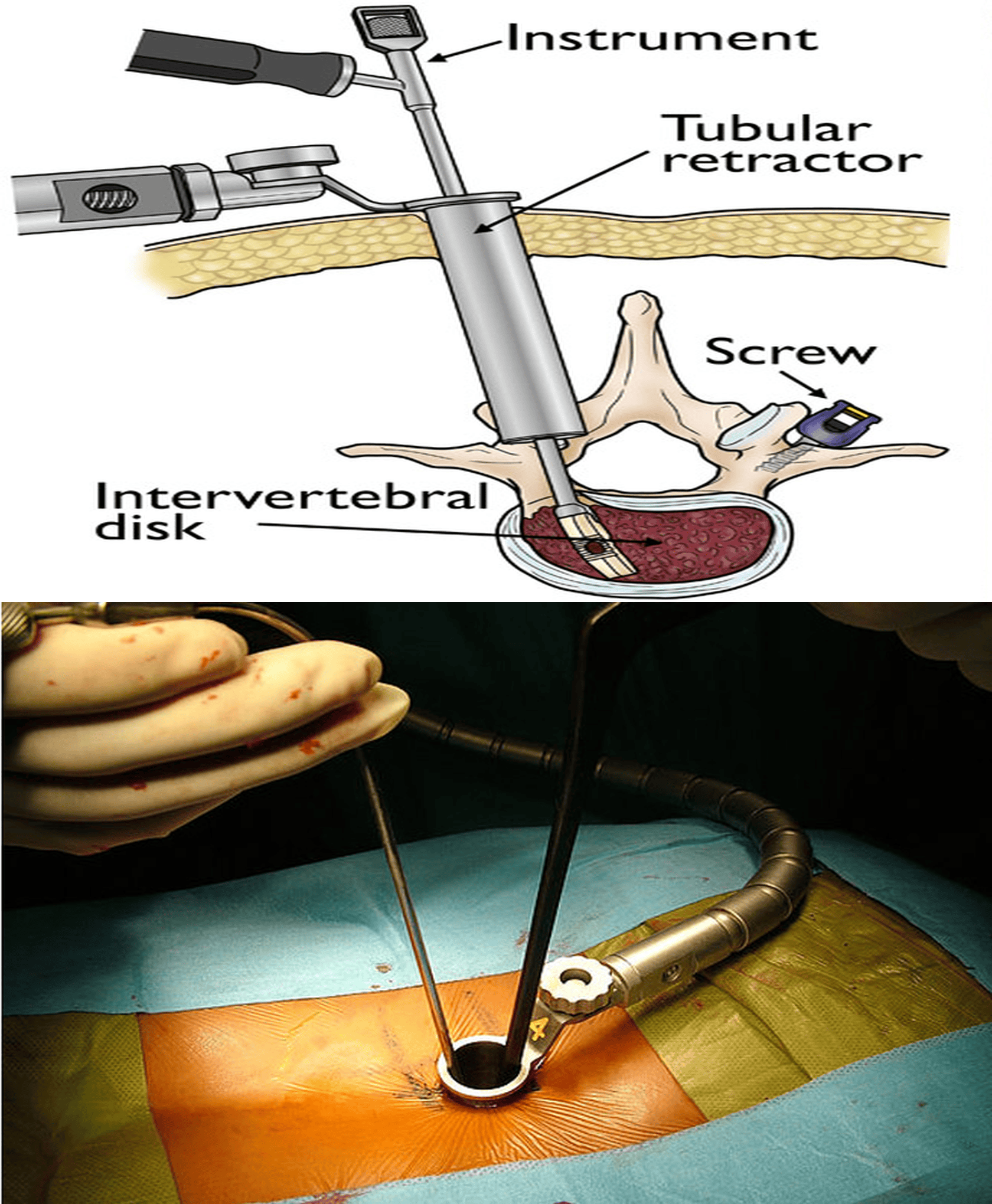 Minimally Invasive Spine Surgery