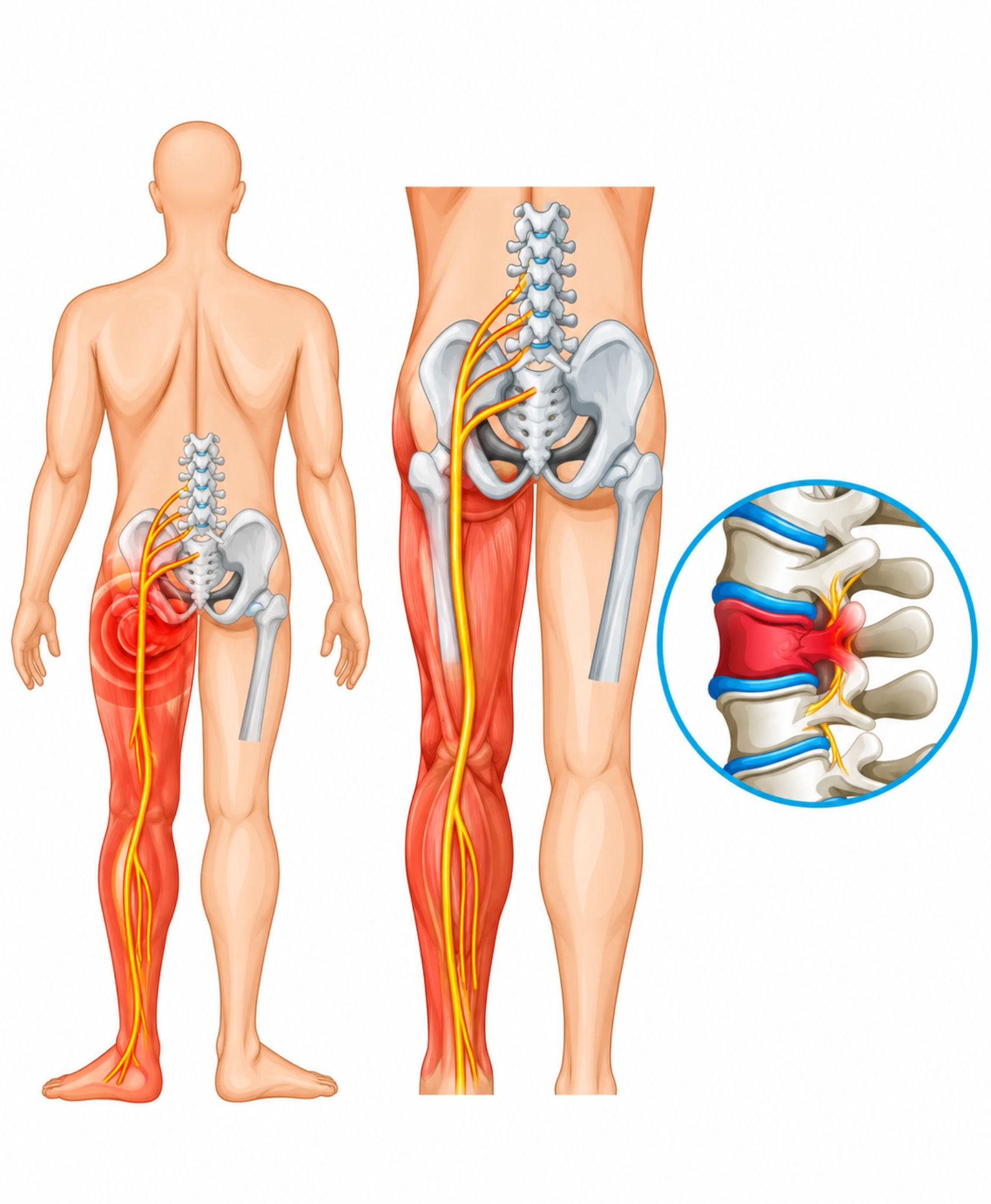 Sciatica Pain