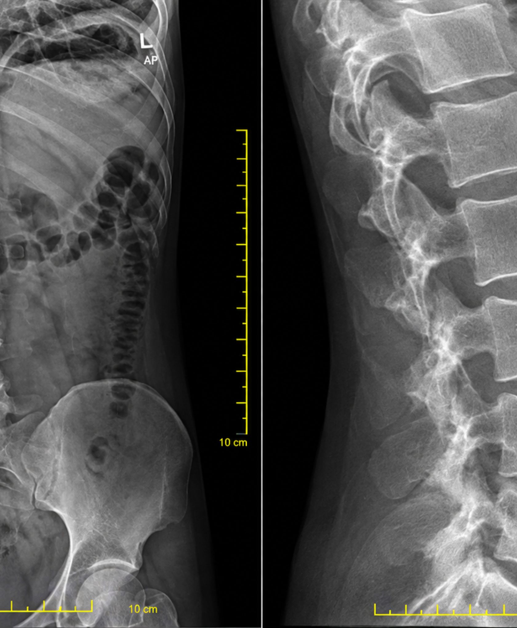 Spinal Fractures & Trauma