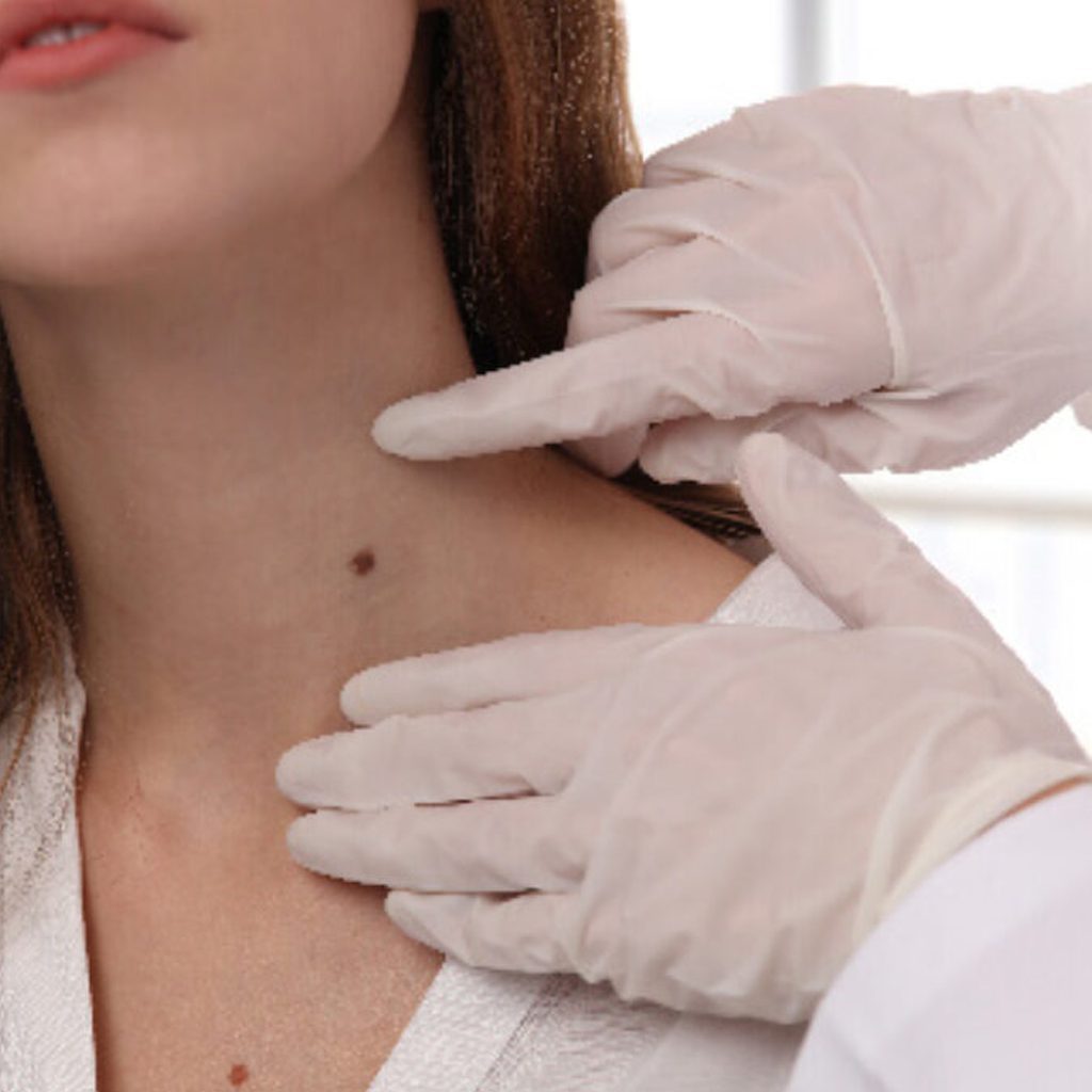 Benign Tumors