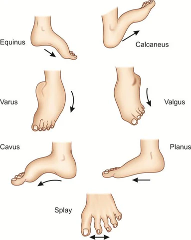 Foot Deformities