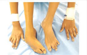 Limb Deformities