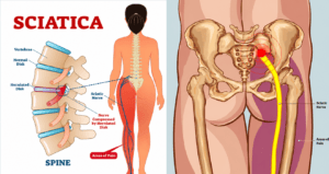 Sciatica Specialist Doctor in Kandivali
