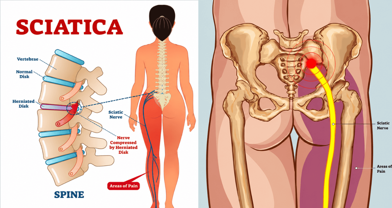 Sciatica Specialist Doctor in Kandivali