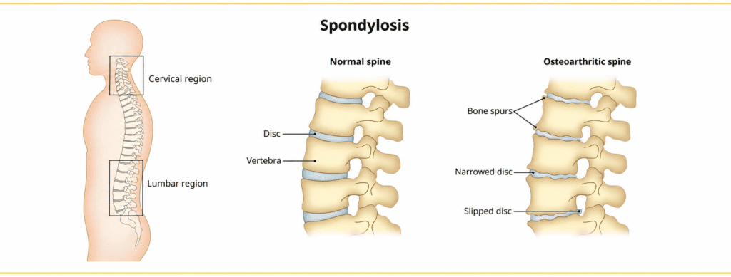 What are the causes and symptoms of spondylosis