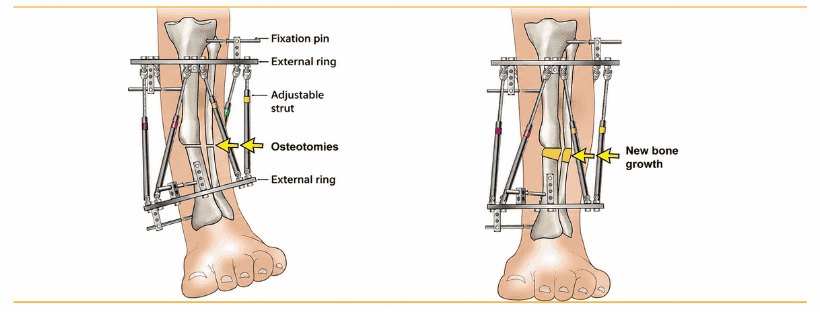 What causes a limb deformity