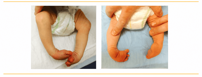 Clubfoot Specialist in Mumbai