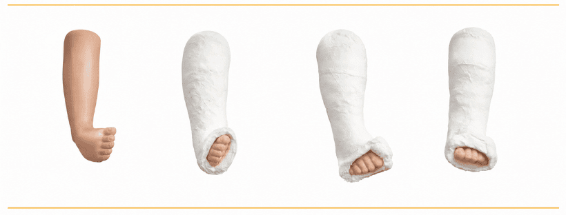 Clubfoot Treatment for Babies and Children