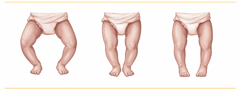 Limb Deformities