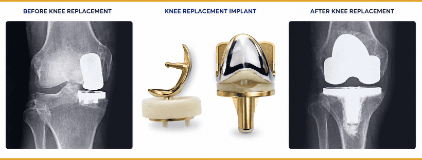 Partial Knee Replacement
