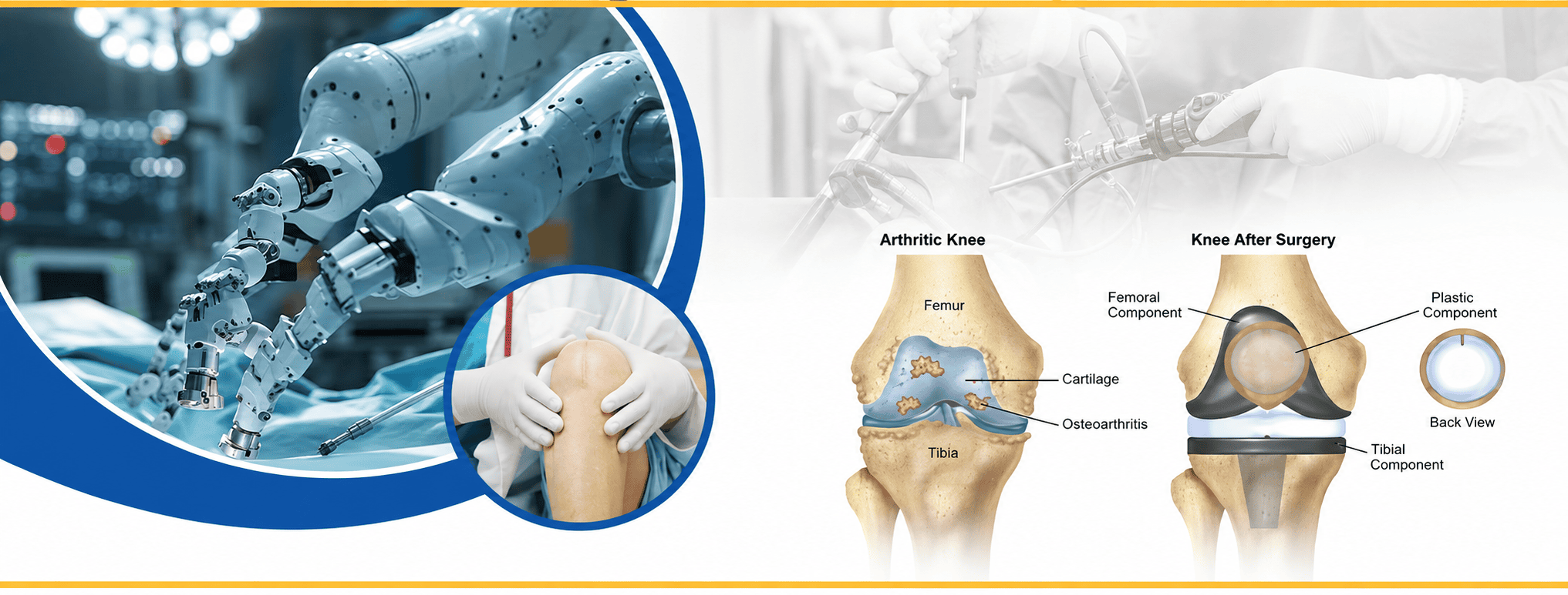 Robotic Knee Replacement in Mumbai