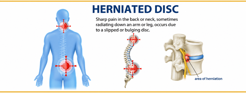 Slip Disc Treatment in Mumbai
