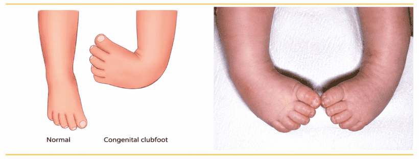 What is Clubfoot Treatment in Mumbai