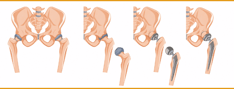 What is Hip Replacement Surgery