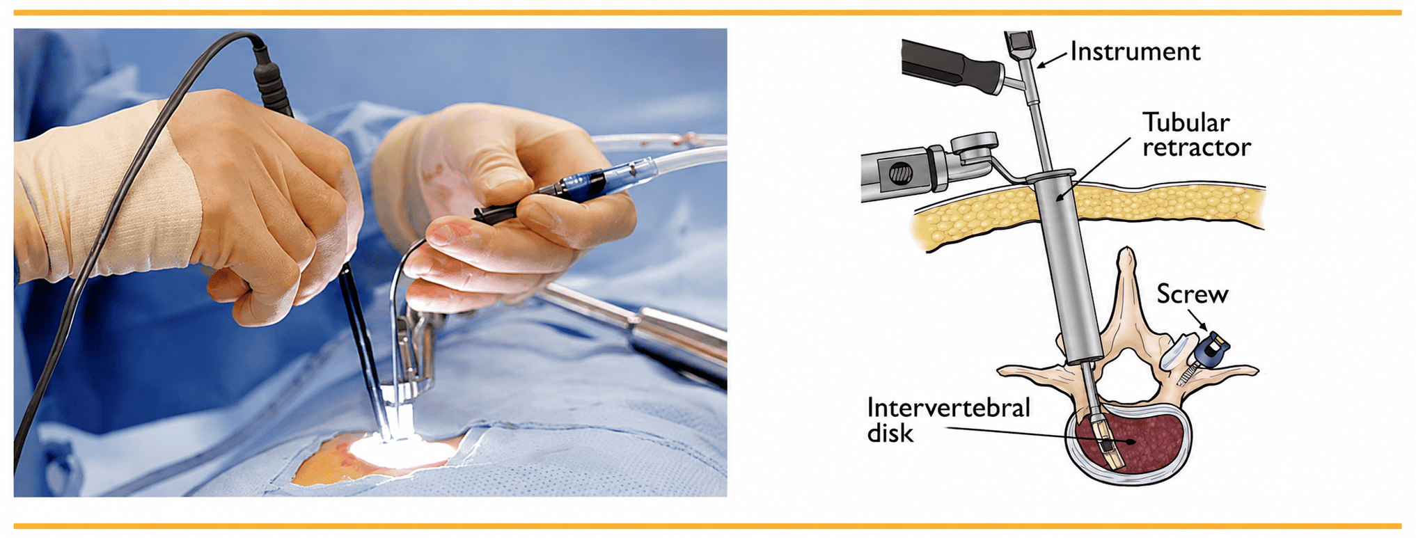 What Is Minimally Invasive Spine Surgery