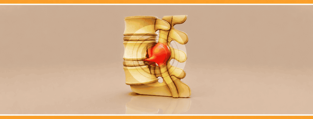 What is Spinal Fracture